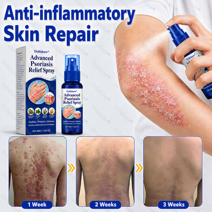 Dobshow® Advanced Psoriasis Relief Spray -Z