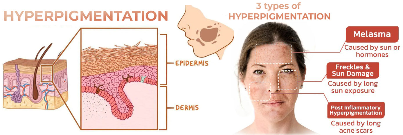 ✨Fast Dark Spot Remover-Dobshow™ Melanin Correcting Facial Serum