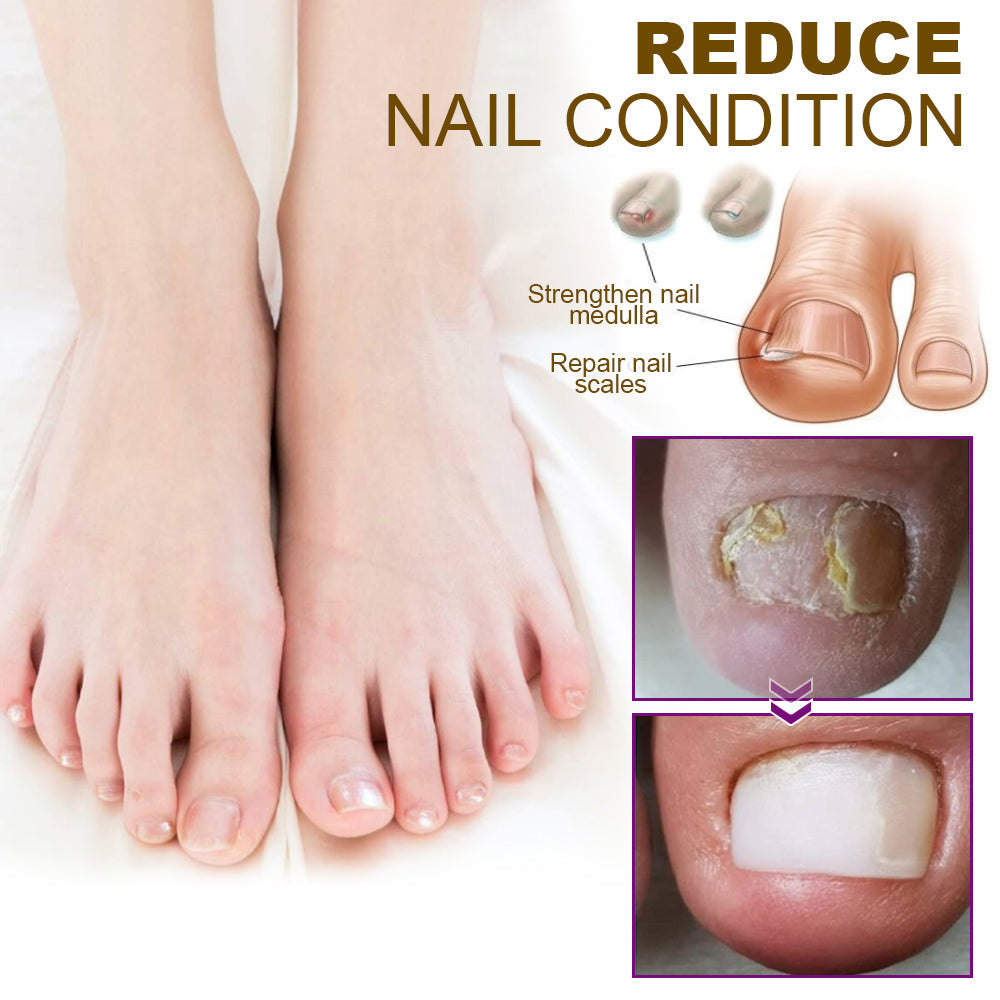 🐝Dobshow™ Fungus-Free Bee Venom Nail Treatment Serum🐝