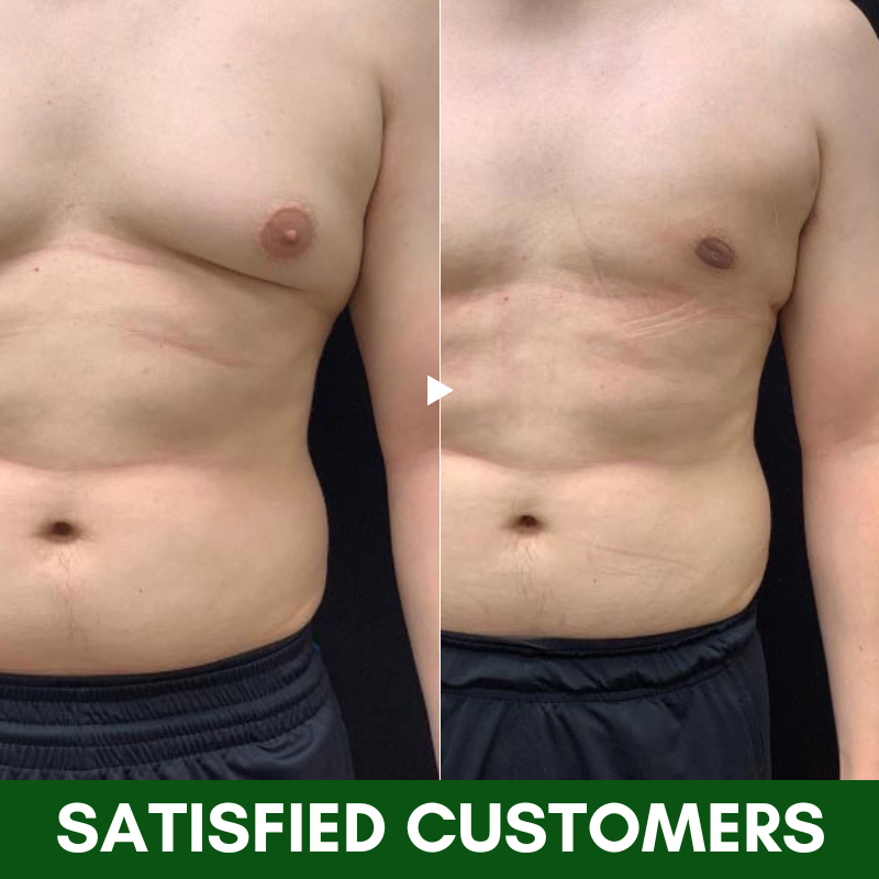 Dobshow™ TurmericMax Gynecomastia Compress Patch