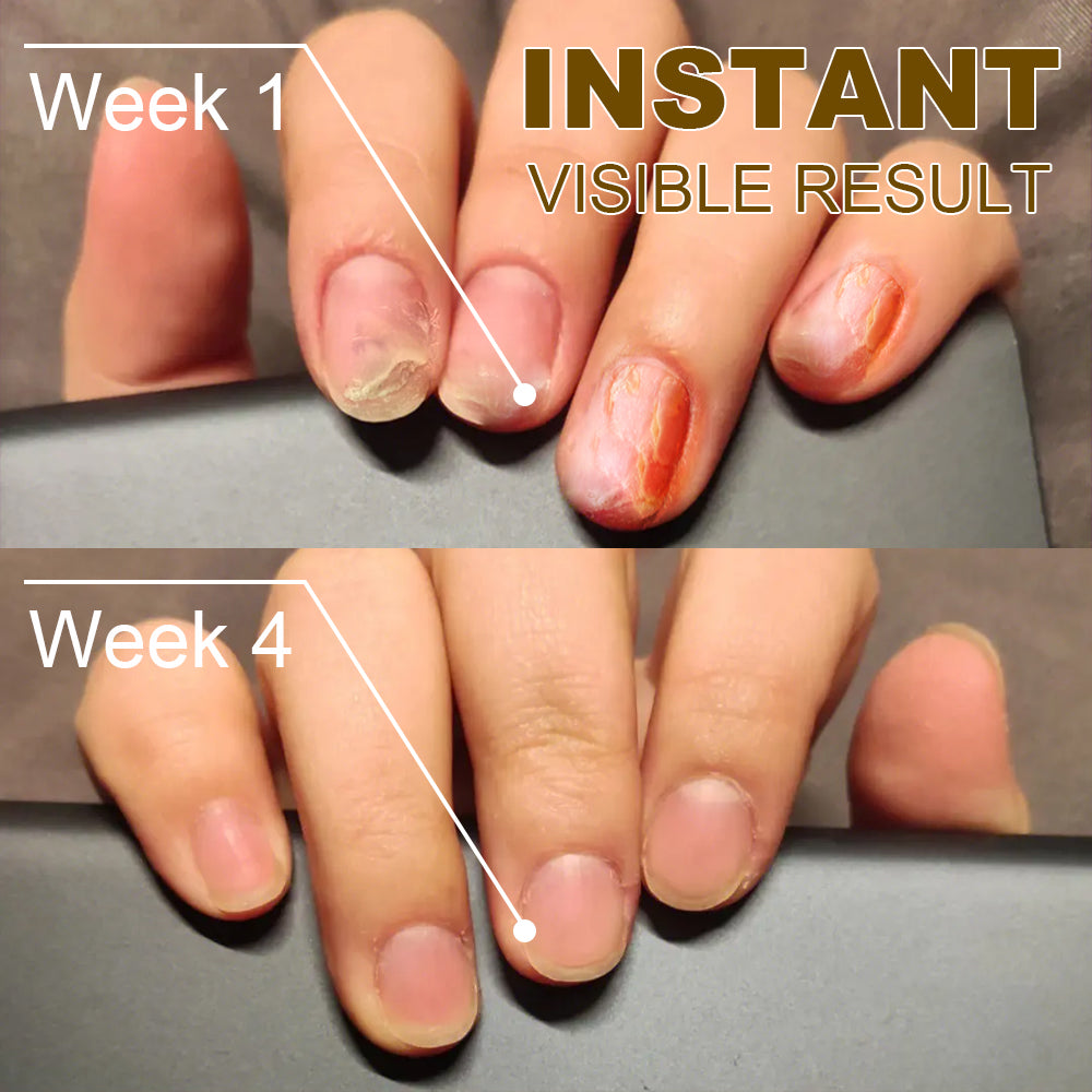 🐝Dobshow™ Fungus-Free Bee Venom Nail Treatment Serum🐝