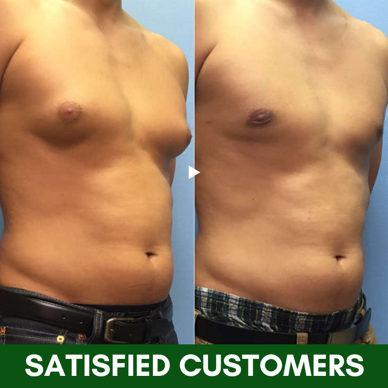 Dobshow™ TurmericMax Gynecomastia Compress Patch