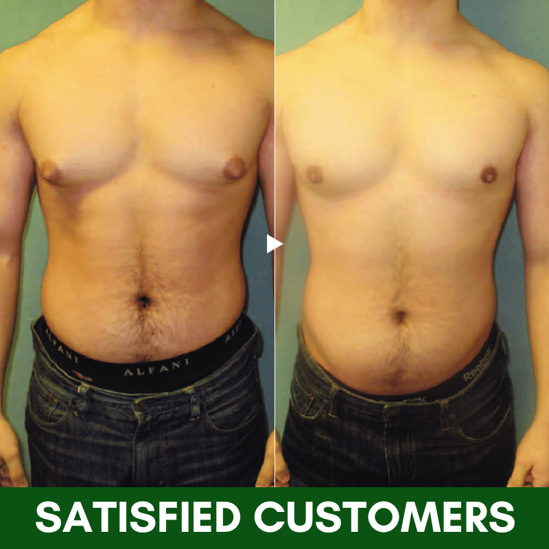 Dobshow™ TurmericMax Gynecomastia Compress Patch