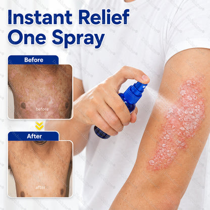 Dobshow® Advanced Psoriasis Relief Spray -Z