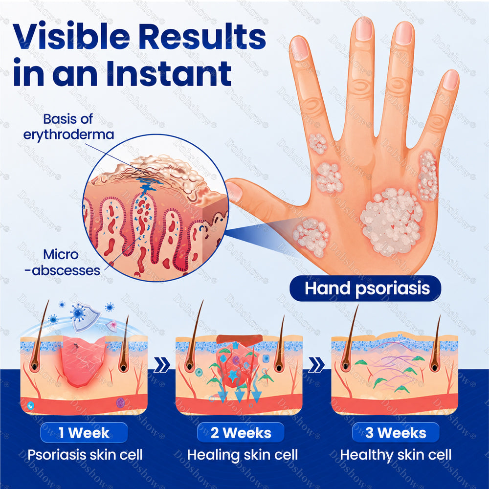 Dobshow® Advanced Psoriasis Relief Spray -Z