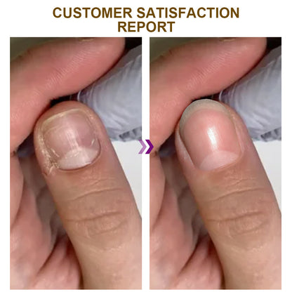 🐝Dobshow™ Fungus-Free Bee Venom Nail Treatment Serum🐝