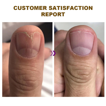 🐝Dobshow™ Fungus-Free Bee Venom Nail Treatment Serum🐝